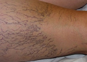 causes des varices dans les jambes